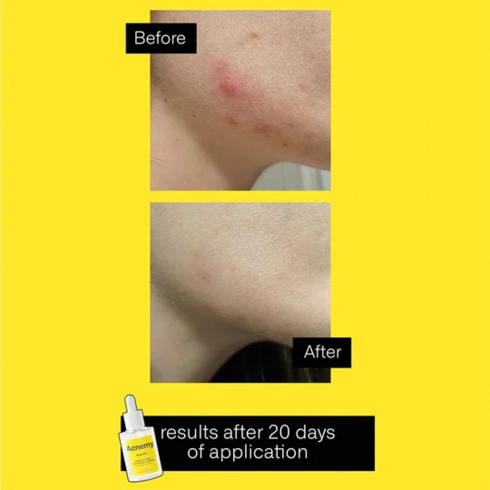 acnemy-postzit-zit-marks-solution-use-1000x1000